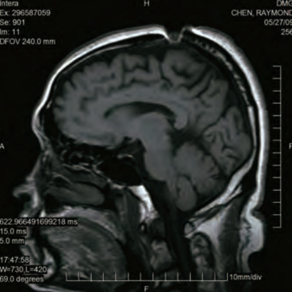 侧面佛法开顶MRI照片